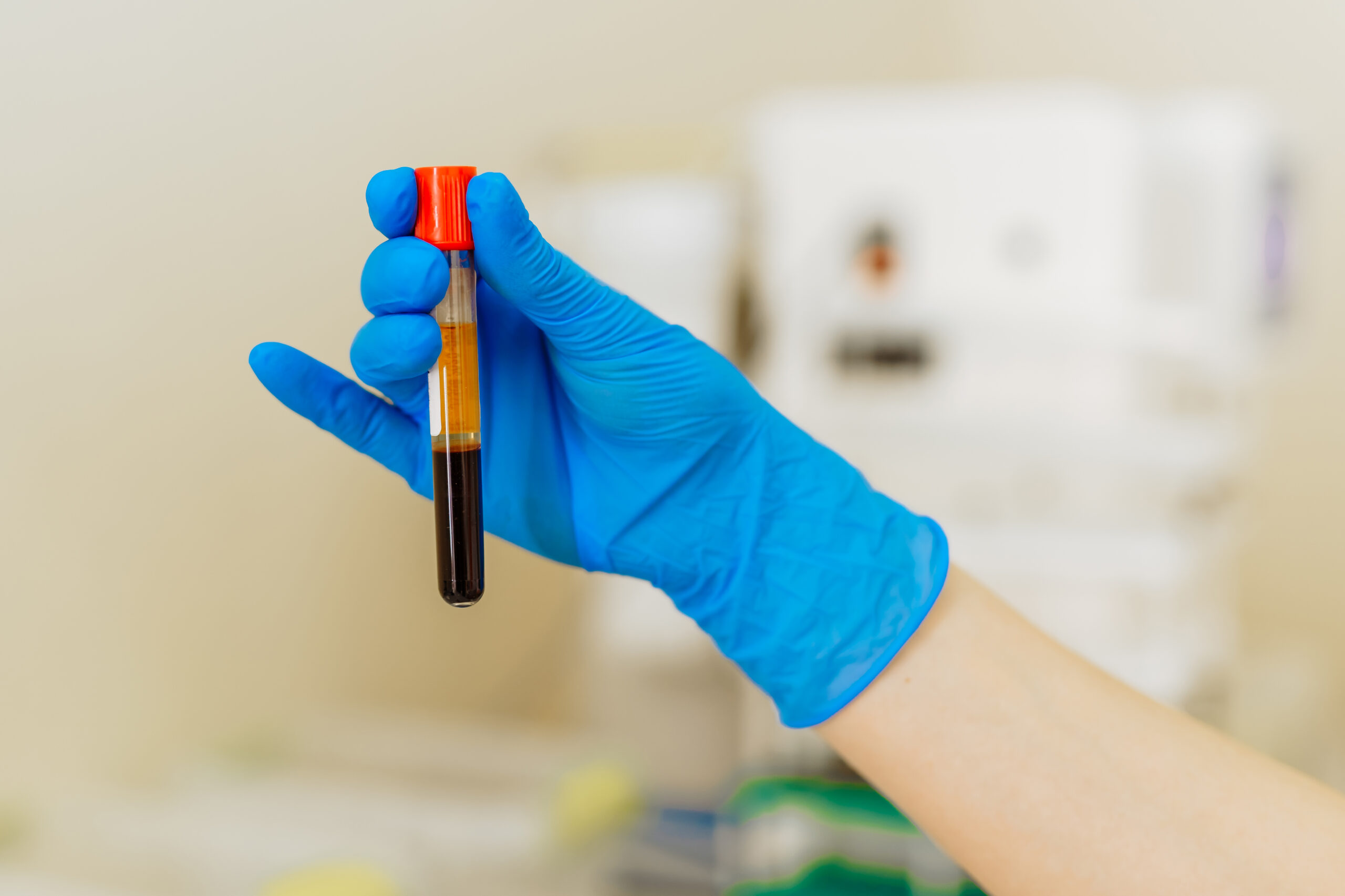 PRP Facial Rejuvenation Los Angeles