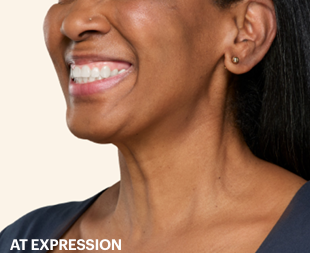 Platysmal Bands after 1