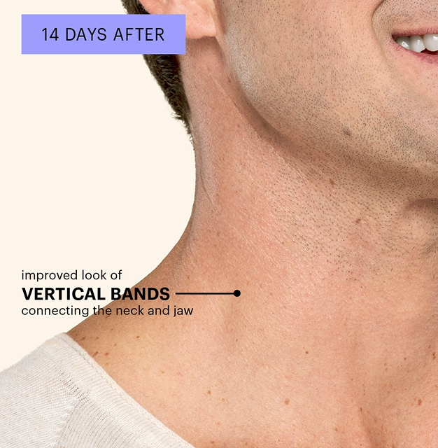 Platysmal Bands after 3