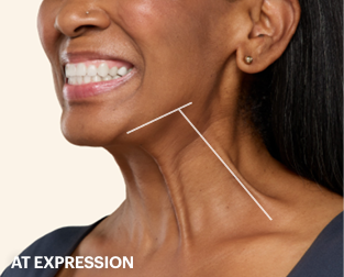 Platysmal Bands before 1