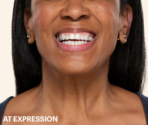 Platysmal bands after 2