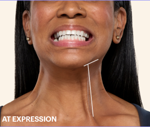 Platysmal bands before 2