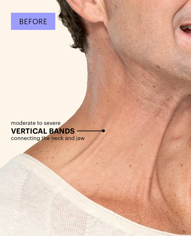 Platysmal bands before 3