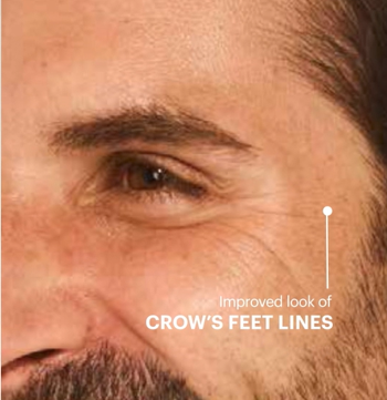 crows feet after 4