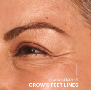 crows feet after 5
