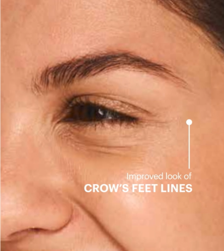 crows feet after 6