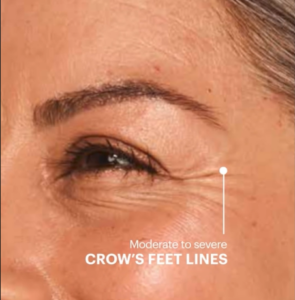crows feet before 5