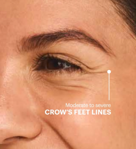 crows feet before 6